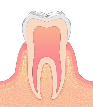 CO：初期の虫歯