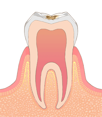C1：エナメル質が溶け始めた虫歯