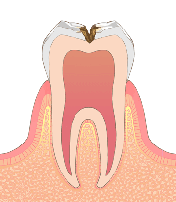 C2：エナメル質より内側の象牙質まで進行した虫歯
